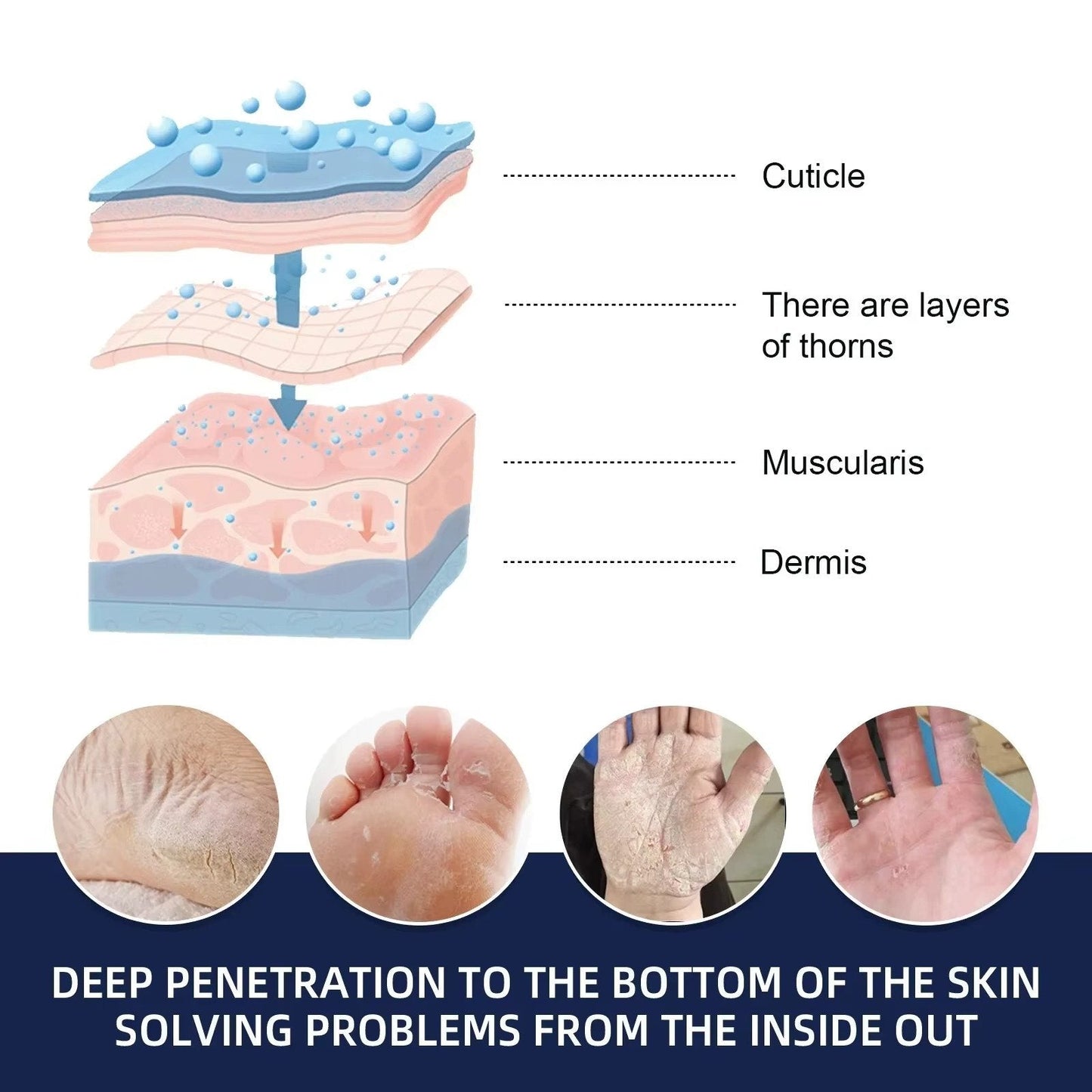 Cracked Foot Heel Treatment