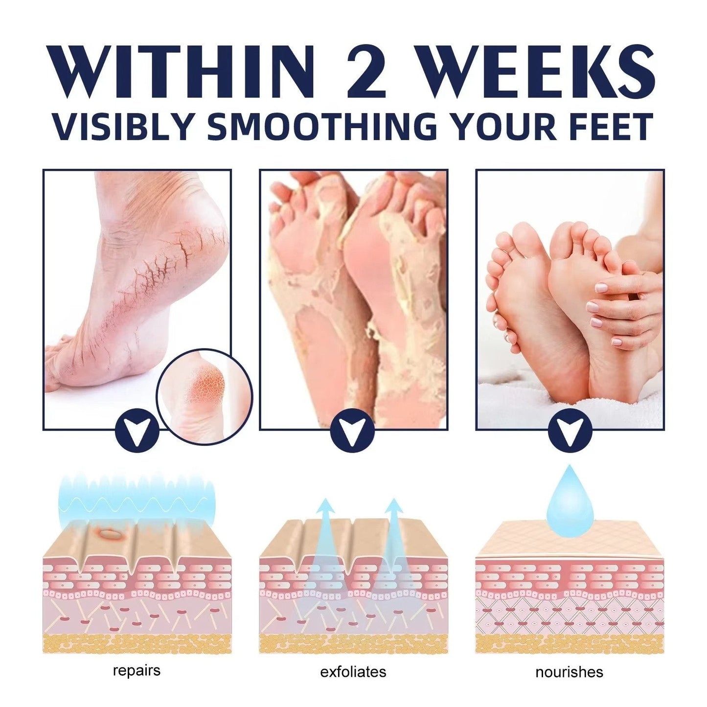 Cracked Foot Heel Treatment