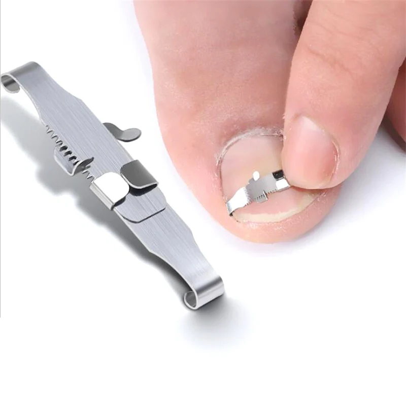 Ingrown Toenail Corrector Tools Health Product Toenail...