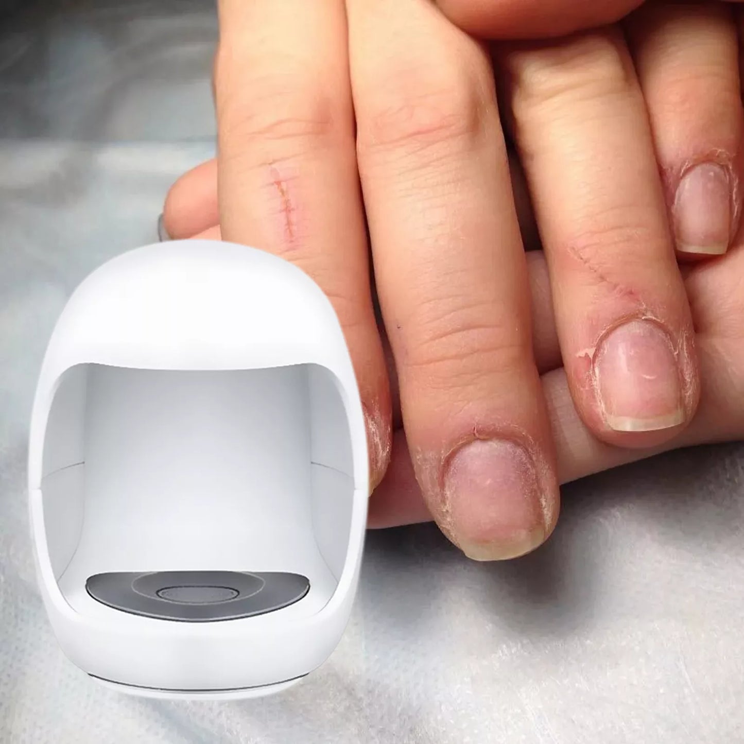 Fungal Laser Toe Treatment Clip on Device
